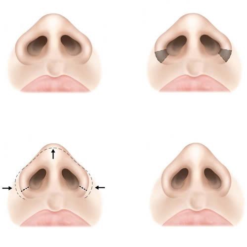 review-can-chinh-canh-mui-co-dau-khong-gia-bao-nhieu-bao-lau-thi-lanh