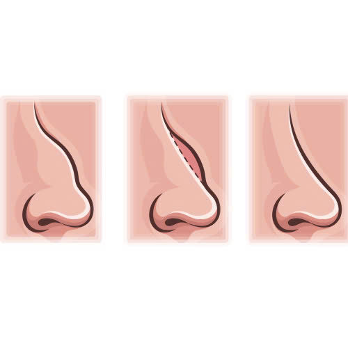 review-mai-go-mui-co-nen-lam-khong-kinh-nghiem-thuc-te-tu-nguoi-da-trai-nghiem