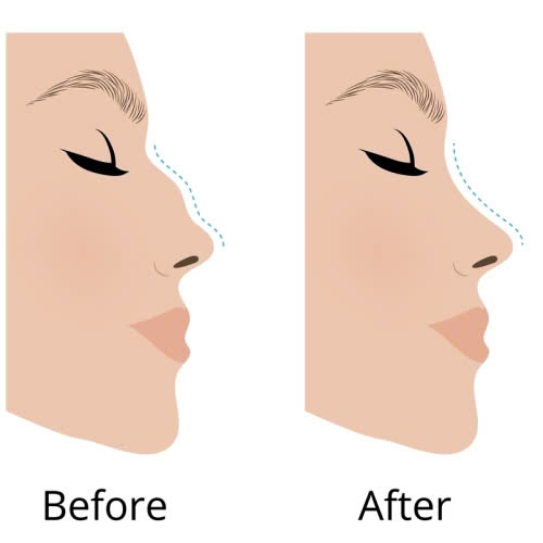 review-mai-go-mui-co-nen-lam-khong-kinh-nghiem-thuc-te-tu-nguoi-da-trai-nghiem