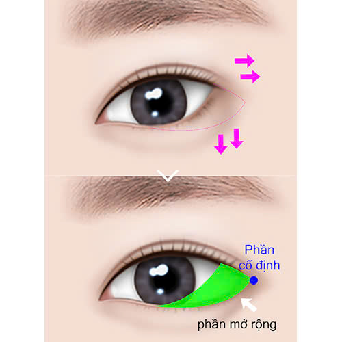 review-mo-goc-mat-ngoai-kinh-nghiem-thuc-te-loi-khuyen-danh-cho-ban