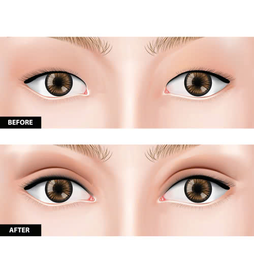 review-mo-goc-mat-trong-co-nen-thuc-hien-hieu-qua-ra-sao