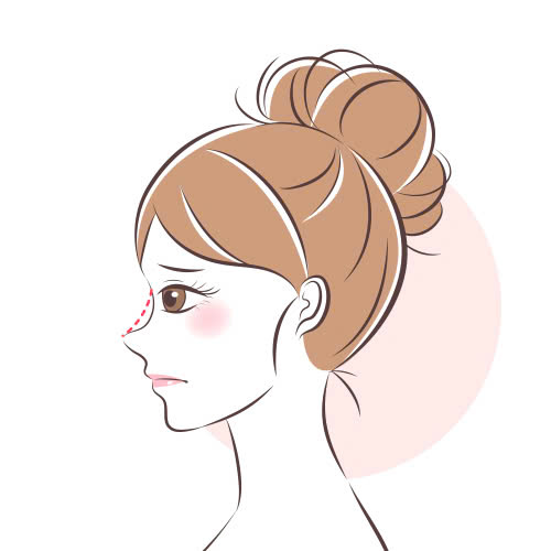 tiem-filler-mui-bi-tan-nhanh-nguyen-nhan-dau-hieu-va-cach-khac-phuc-hieu-qua