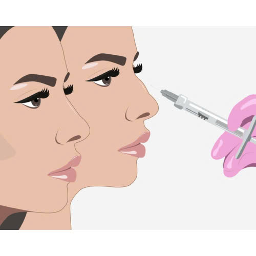 tiem-filler-mui-chinh-song-mui-go-bao-lau-thi-dep-co-nguy-hiem-khong