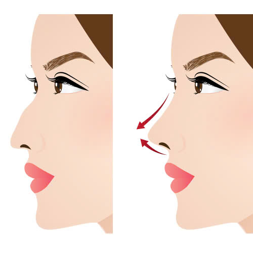 tiem-filler-mui-chinh-song-mui-go-bao-lau-thi-dep-co-nguy-hiem-khong