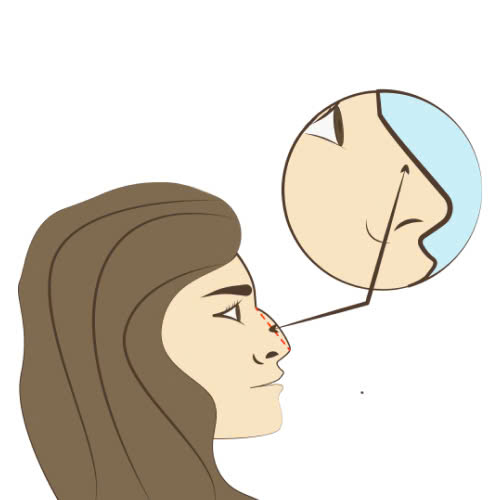 tiem-filler-mui-chinh-song-mui-go-bao-lau-thi-dep-co-nguy-hiem-khong