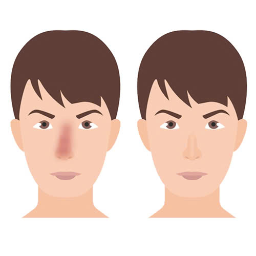 tiem-filler-mui-co-nguy-hiem-khong-su-that-ai-cung-nen-biet-truoc-khi-lam-dep