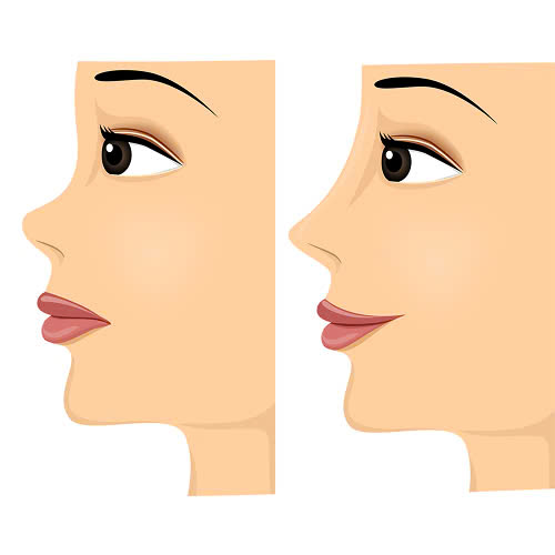 tiem-filler-mui-giu-duoc-bao-lau-giai-dap-chi-tiet-cach-keo-dai-hieu-qua