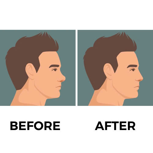 tiem-filler-mui-khac-phuc-mui-tet-giai-phap-lam-dep-khong-dao-keo