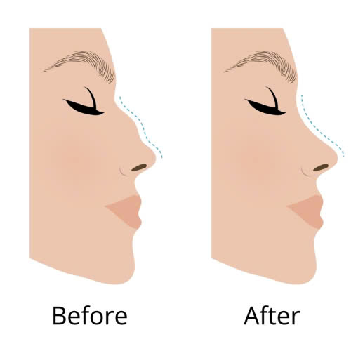 tiem-filler-mui-tu-tan-sau-bao-lau-4-yeu-to-anh-huong-den-thoi-gian-tan-filler