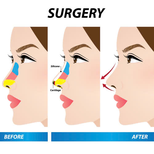 tiem-filler-mui-va-nang-mui-nen-chon-cai-nao-cho-dang-mui-dep-tu-nhien-va-an-toan
