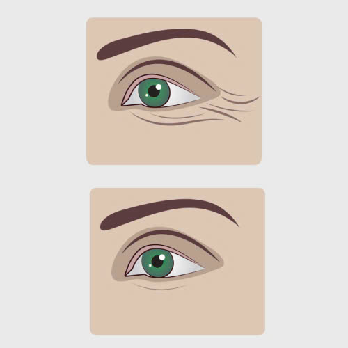 cang-chi-xoa-nhan-duoi-mat-gia-bao-nhieu-chi-phi-phu-thuoc-vao-nhung-yeu-to-nao