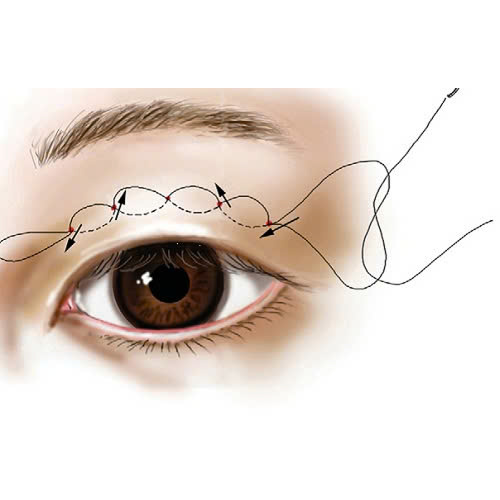 cat-mat-2-mi-full-bi-sung-bao-lau-va-cach-giam-sung-hieu-qua