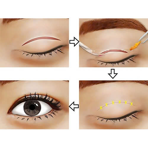 cat-mi-full-ket-hop-lay-mo-mi-mat-giai-phap-khac-phuc-mat-sup-bong-mo-hieu-qua