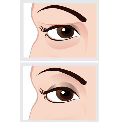 cat-mi-full-ket-hop-lay-mo-mi-mat-giai-phap-khac-phuc-mat-sup-bong-mo-hieu-qua