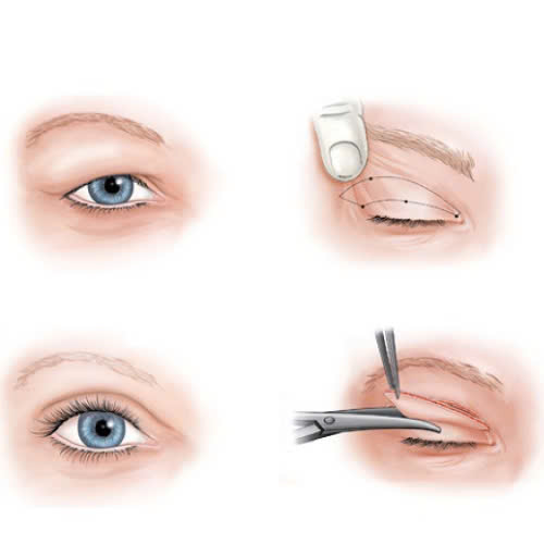 cat-mi-mat-cho-nguoi-lon-tuoi-quy-trinh-loi-ich-va-nhung-dieu-can-biet