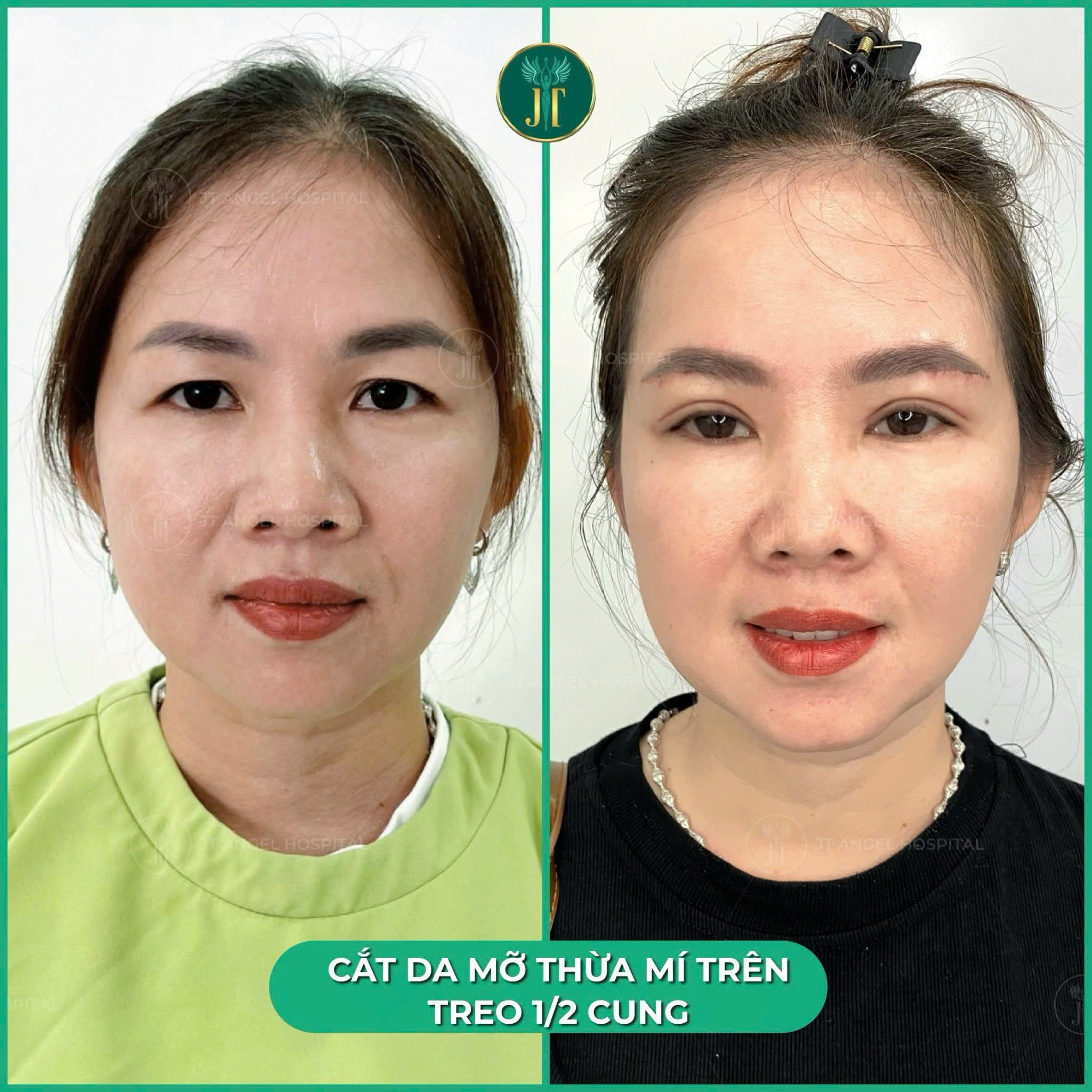 hinh-anh-truoc-sau-cat-mat-2-mi-full-bang-chung-ro-rang-cho-man-thay-doi-van-menh