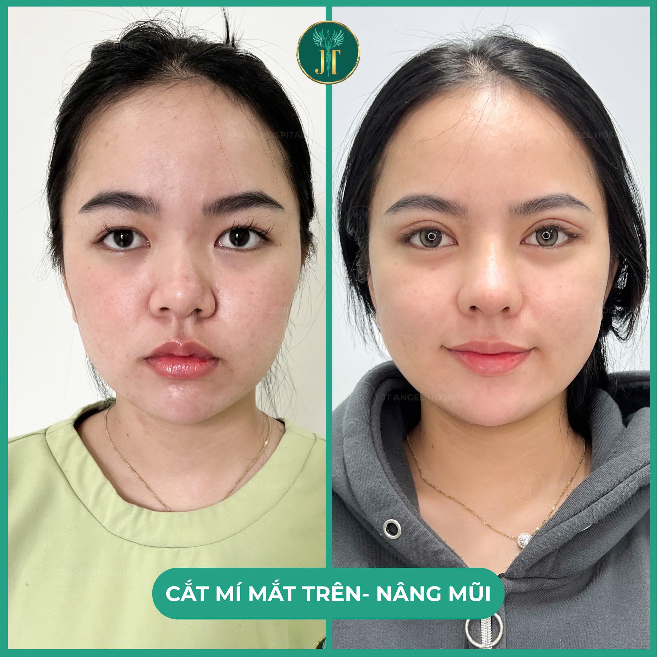 hinh-anh-truoc-sau-cat-mat-2-mi-full-bang-chung-ro-rang-cho-man-thay-doi-van-menh