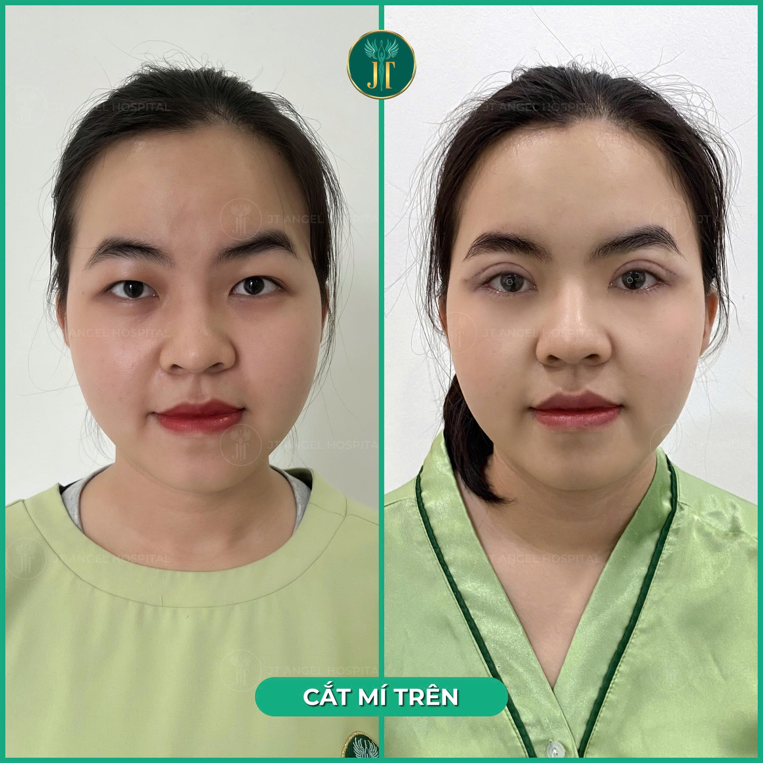 hinh-anh-truoc-sau-cat-mat-2-mi-full-bang-chung-ro-rang-cho-man-thay-doi-van-menh
