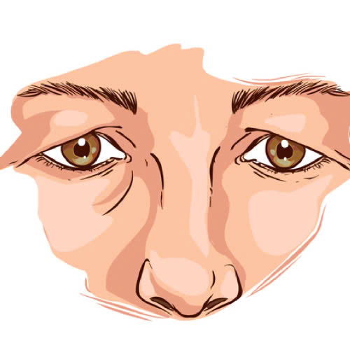 mi-mat-bi-sup-phai-lam-sao-nguyen-nhan-va-giai-phap-an-toan-hieu-qua