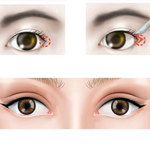 mo-goc-mat-ngoai-co-lam-thay-doi-tuong-so-khong-dep-hon-va-co-the-doi-van-hay-khong