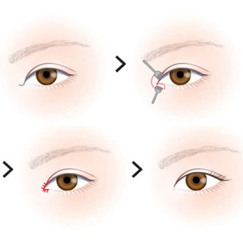 mo-goc-mat-trong-cho-mat-mi-lot-giai-phap-mo-khoa-doi-mat-to-tron-cuon-hut