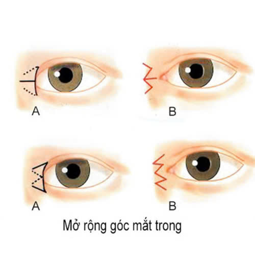 su-that-ve-mo-goc-mat-trong-cho-nam-gioi-hieu-dung-de-dep-dung-cach