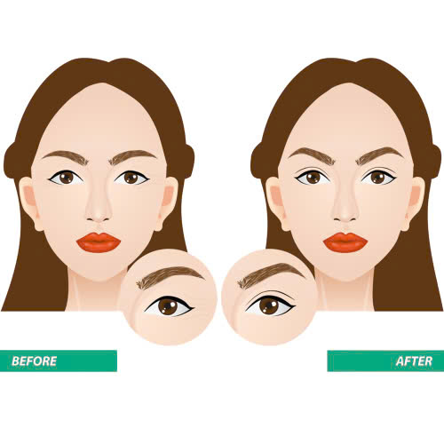 phau-thuat-tao-hinh-mat-trung-hoa-la-gi-cung-tim-hieu-ve-quy-trinh-uu-diem-va-nhung-ai-phu-hop-thuc-hien-phuong-phap-lam-dep-nay