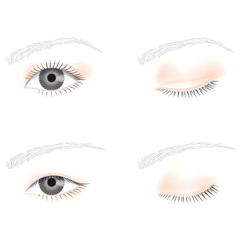 phau-thuat-tao-hinh-mat-trung-hoa-la-gi-cung-tim-hieu-ve-quy-trinh-uu-diem-va-nhung-ai-phu-hop-thuc-hien-phuong-phap-lam-dep-nay