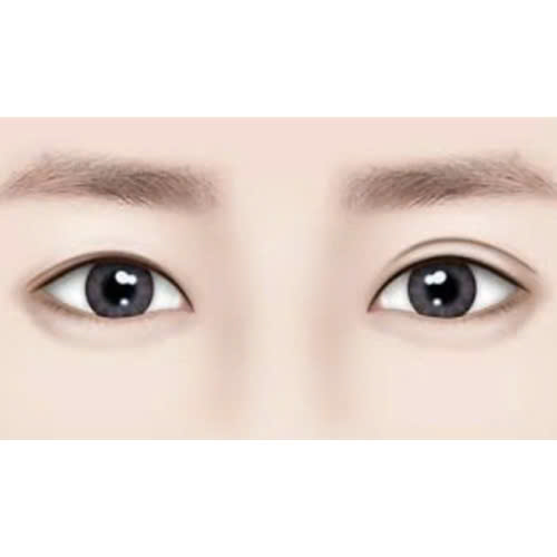 phau-thuat-tao-mi-mat-cuoi-la-gi-cung-tim-hieu-ve-quy-trinh-loi-ich-va-luu-y-khi-thuc-hien-phuong-phap-nay