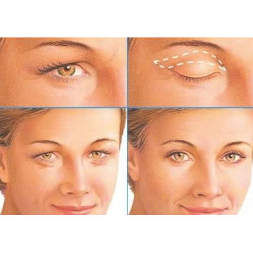 quy-trinh-cat-mat-2-mi-full-bo-da-thua-tat-ca-nhung-gi-ban-can-biet