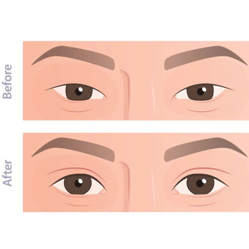 tao-hinh-mat-trung-dong-la-gi-bi-quyet-so-huu-doi-mat-sau-cuon-hut