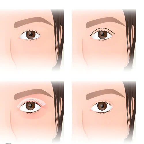 tao-hinh-mat-trung-hoa-gia-bao-nhieu-tham-khao-bang-gia-chi-tiet-va-nhung-yeu-to-anh-huong-den-chi-phi