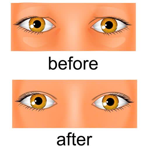 tao-mat-phuong-trung-hoa-la-gi-uu-diem-quy-trinh-va-nhung-dieu-can-luu-y