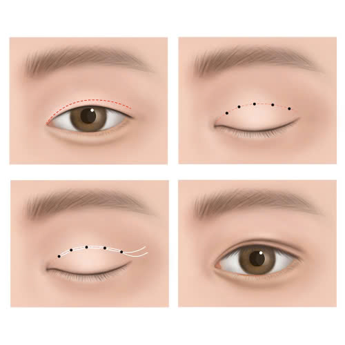 tao-mi-mat-cuoi-gia-bao-nhieu-nhung-luu-y-ve-gia-khi-chon-co-so-tham-my-de-quyet-dinh-lot-xac-doi-mat