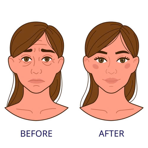 cang-chi-duoi-mat-co-bi-sung-khong-cung-tim-hieu-nhung-yeu-to-anh-huong-den-muc-do-sung-sau-khi-cang-chi