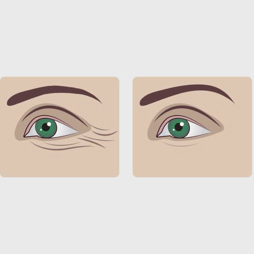 cang-chi-duoi-mat-co-bi-sung-khong-cung-tim-hieu-nhung-yeu-to-anh-huong-den-muc-do-sung-sau-khi-cang-chi