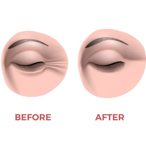 cang-chi-duoi-mat-ket-hop-tiem-filler-bi-quyet-tre-hoa-tu-nhien-giup-cho-doi-mat-rang-ngoi