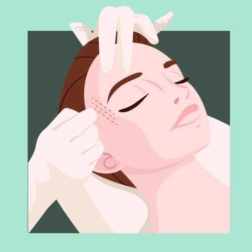 cang-chi-xoa-nhan-duoi-mat-bang-chi-collagen-la-gi-cung-tim-hieu-ve-uu-diem-quy-trinh-va-doi-tuong-phu-hop-thuc-hien-dich-vu-nay