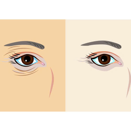 cang-chi-xoa-nhan-duoi-mat-co-dau-khong