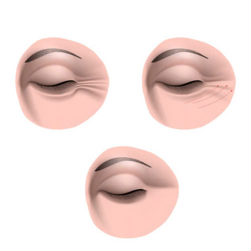 uu-va-nhuoc-diem-cua-cang-chi-xoa-nhan-duoi-mat-khong-phau-thuat-ban-nen-biet