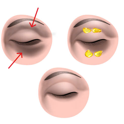 cay-mo-hoc-mat-bao-lau-thi-lanh-giai-dap-chi-tiet-tu-cac-giai-doan-hoi-phuc-cua-phuong-phap-lam-dep-nay