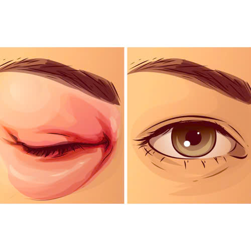 cay-mo-hoc-mat-bi-hong-phai-lam-sao-giai-dap-chi-tiet-dau-hieu-nguyen-nhan-va-cac-giai-phap-khac-phuc-hieu-qua