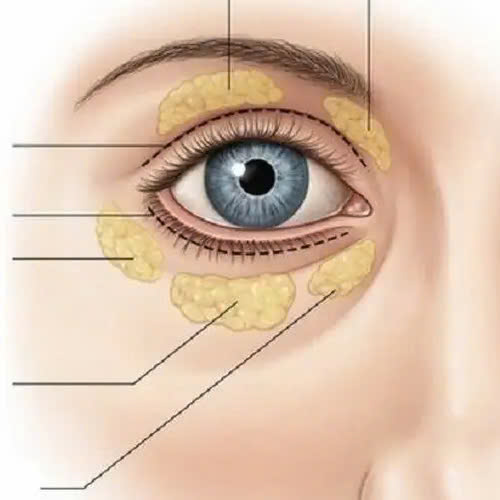 cay-mo-hoc-mat-co-dau-khong-he-lo-bi-quyet-giam-dau-va-hoi-phuc-nhanh-sau-cay-mo-hoc-mat