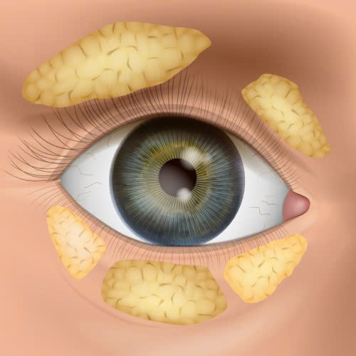 cay-mo-hoc-mat-co-dau-khong-he-lo-bi-quyet-giam-dau-va-hoi-phuc-nhanh-sau-cay-mo-hoc-mat