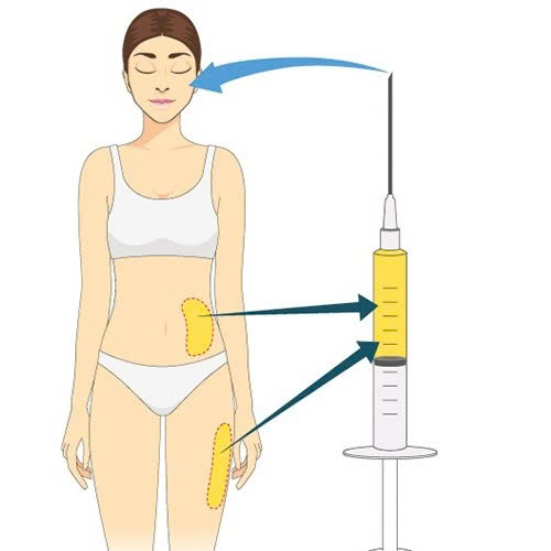 cay-mo-hoc-mat-la-gi-giai-phap-giup-ban-khac-phuc-hoc-mat-trung-sau-an-toan-hieu-qua