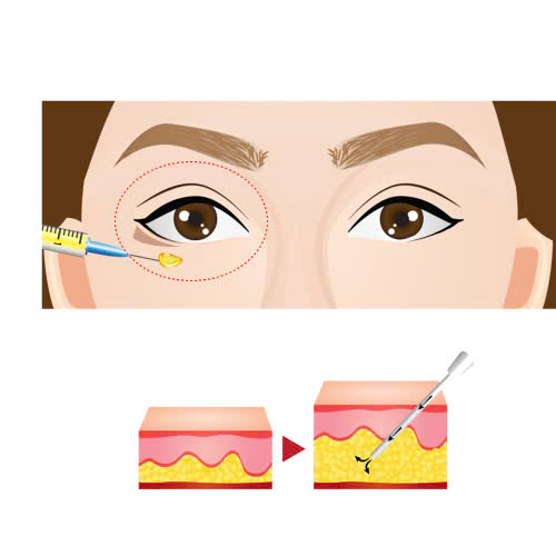 cay-mo-hoc-mat-la-gi-giai-phap-giup-ban-khac-phuc-hoc-mat-trung-sau-an-toan-hieu-qua