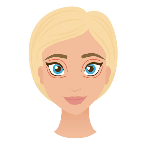 cay-mo-hoc-mat-la-gi-giai-phap-giup-ban-khac-phuc-hoc-mat-trung-sau-an-toan-hieu-qua