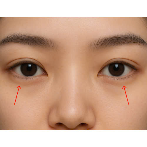 cay-mo-mi-mat-cuoi-bao-lau-thi-lanh-cung-tim-hieu-cac-moc-thoi-gian-hoi-phuc-pho-bien-truoc-khi-quyet-dinh