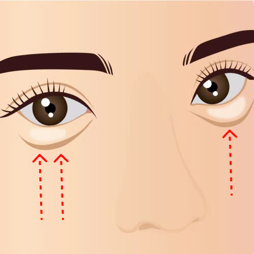 cay-mo-mi-mat-cuoi-bi-von-cuc-cung-tim-hieu-ve-nguyen-nhan-cach-khac-phuc-va-phong-tranh-hieu-qua-sau-khi-cay-mo