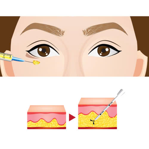 thuc-te-cay-mo-mi-mat-cuoi-co-dau-khong-va-hoi-phuc-trong-bao-lau